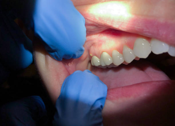 Best Tooth Infection Emergency Dentist  in Unicoi, TN